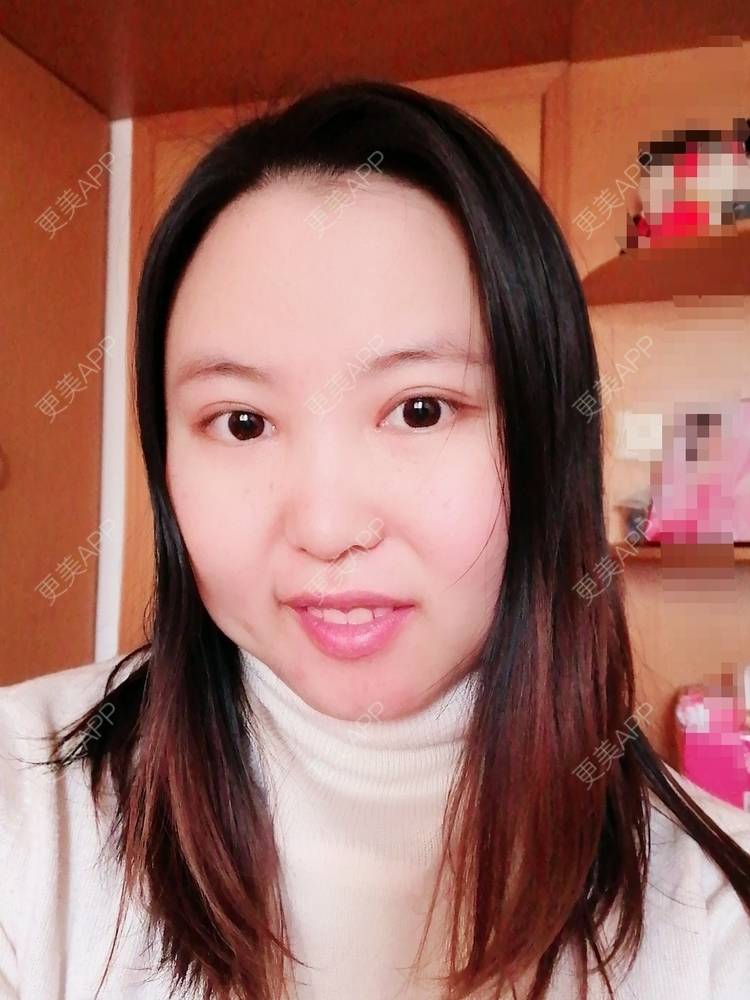 更美 - 飞咪兔兔´ω`的埋线双眼皮经验 | 埋线双眼皮 | 开内眼角 | 自体脂肪丰太阳穴 | 自体脂肪丰额头 | 内眦赘皮矫正