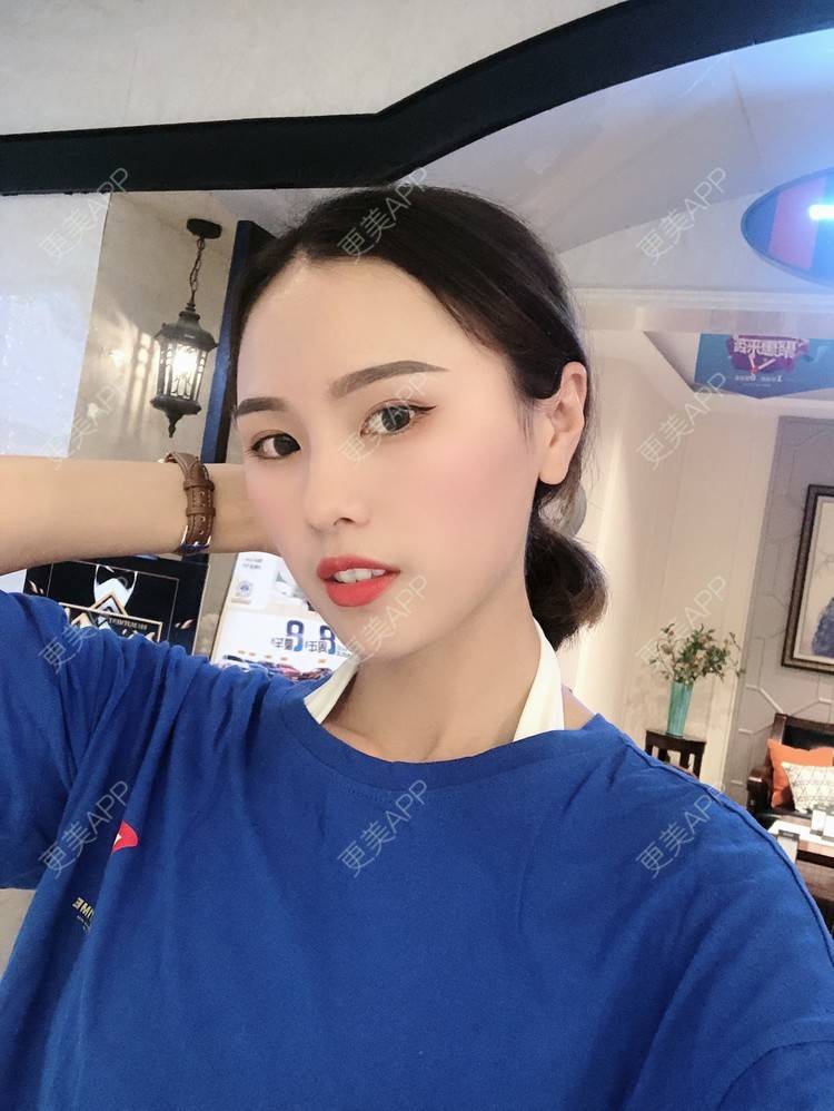 更美 - 更美用户TOjE4YH38k的隆鼻经验 | 北京 | 视频日记 | 隆鼻