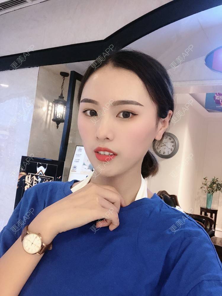 更美 - 更美用户TOjE4YH38k的隆鼻经验 | 北京 | 视频日记 | 隆鼻