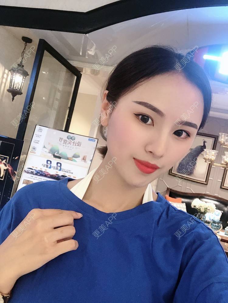 更美 - 更美用户TOjE4YH38k的隆鼻经验 | 北京 | 视频日记 | 隆鼻