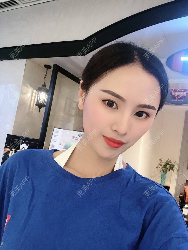 更美 - 更美用户TOjE4YH38k的隆鼻经验 | 北京 | 视频日记 | 隆鼻