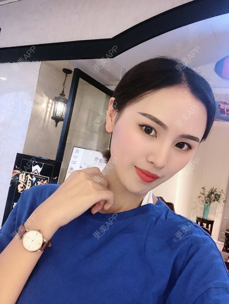 更美 - 更美用户TOjE4YH38k的隆鼻经验 | 北京 | 视频日记 | 隆鼻