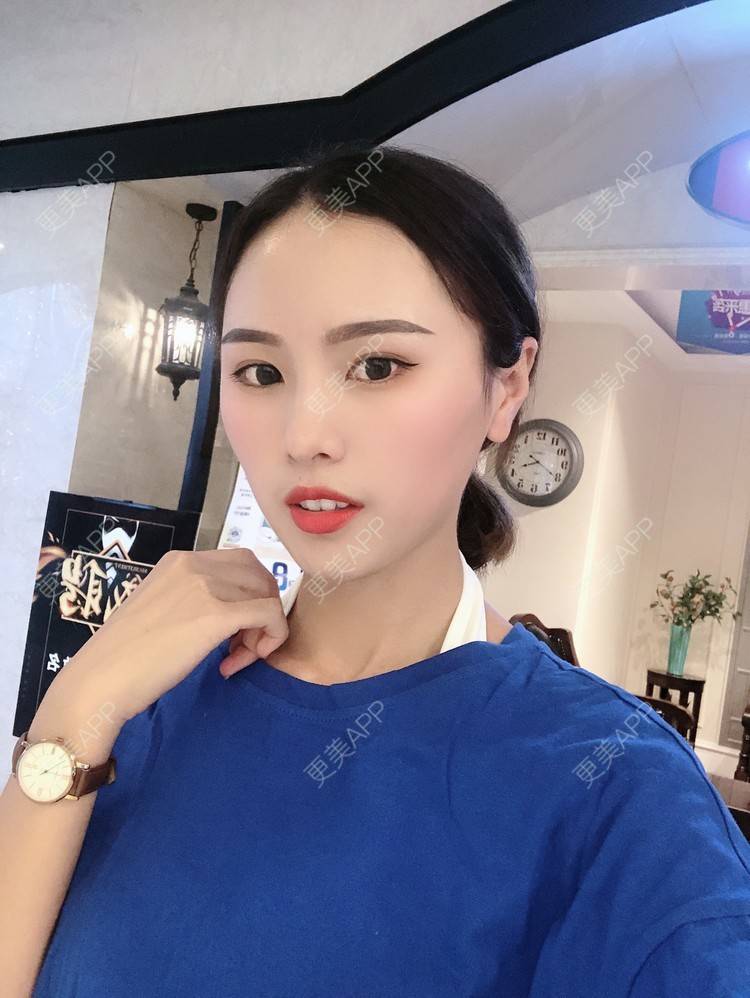 更美 - 更美用户TOjE4YH38k的隆鼻经验 | 北京 | 视频日记 | 隆鼻