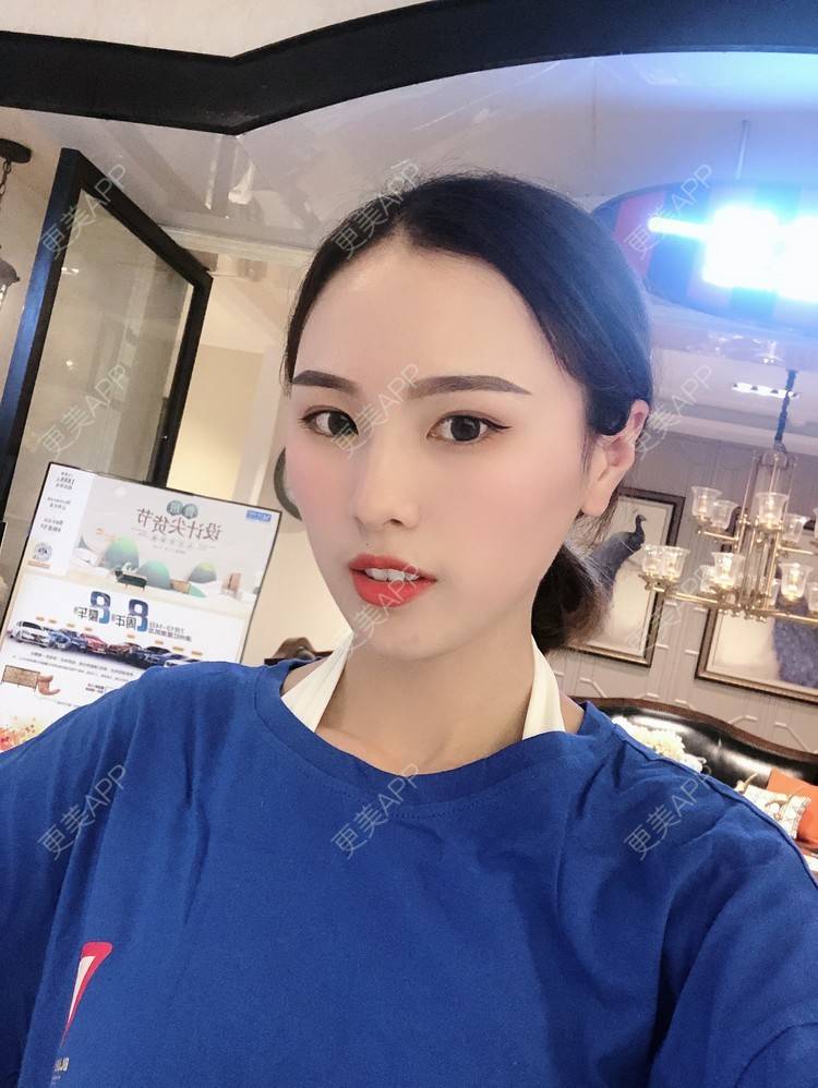 更美 - 更美用户TOjE4YH38k的隆鼻经验 | 北京 | 视频日记 | 隆鼻