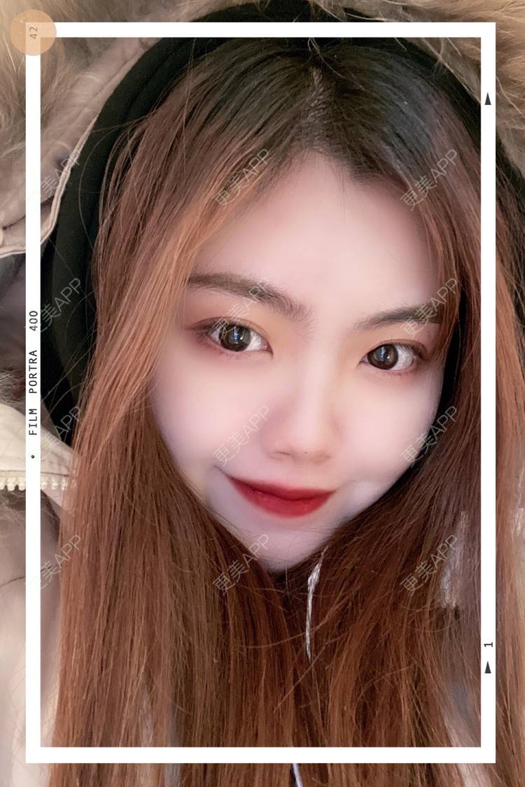 更美 - 旺旺掀被。的双眼皮经验 | 双眼皮 | 全切双眼皮 | 开内眼角 | 长沙 | 上眼睑去脂 | 眼部多项