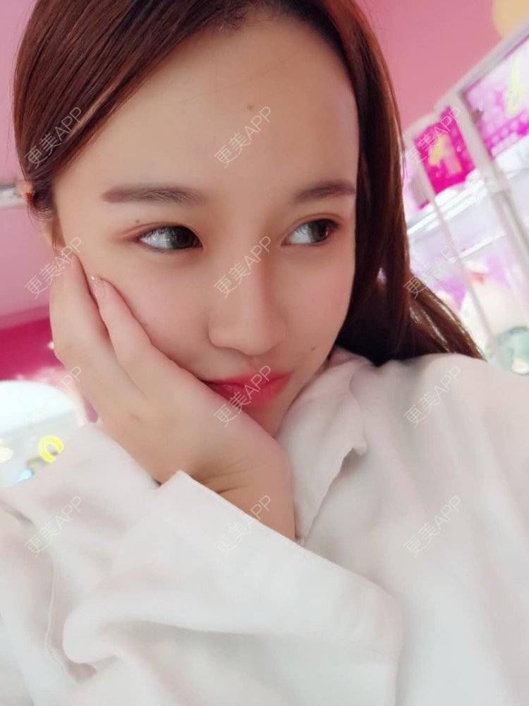 更美 - 辰星✨的隆鼻经验 | 鼻基底 | 视频日记 | 自体软骨垫鼻尖 | 隆鼻 | 鼻部多项 | 武汉 | 鼻翼