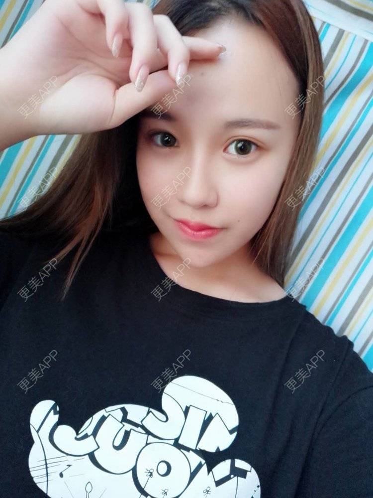 更美 - 辰星✨的隆鼻经验 | 鼻基底 | 视频日记 | 自体软骨垫鼻尖 | 隆鼻 | 鼻部多项 | 武汉 | 鼻翼