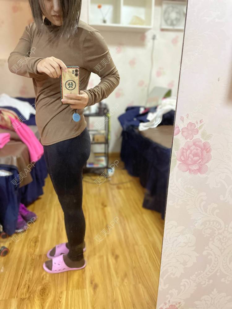 更美 - 誐吥渼、狚婧堔己的吸脂经验 | 吸脂 | 吸脂瘦大腿 | 北京 | 视频日记