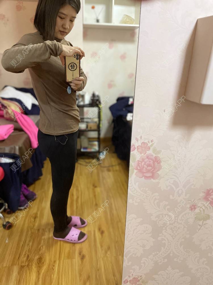 更美 - 誐吥渼、狚婧堔己的吸脂经验 | 吸脂 | 吸脂瘦大腿 | 北京 | 视频日记