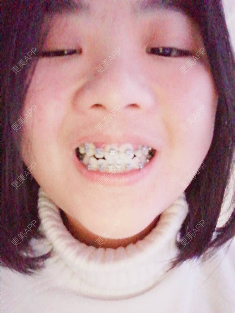 更美 - 鱼不咸咸的金属托槽矫正经验 | 金属托槽矫正 | 成都