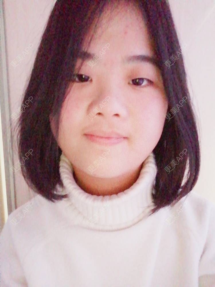 更美 - 鱼不咸咸的金属托槽矫正经验 | 金属托槽矫正 | 成都
