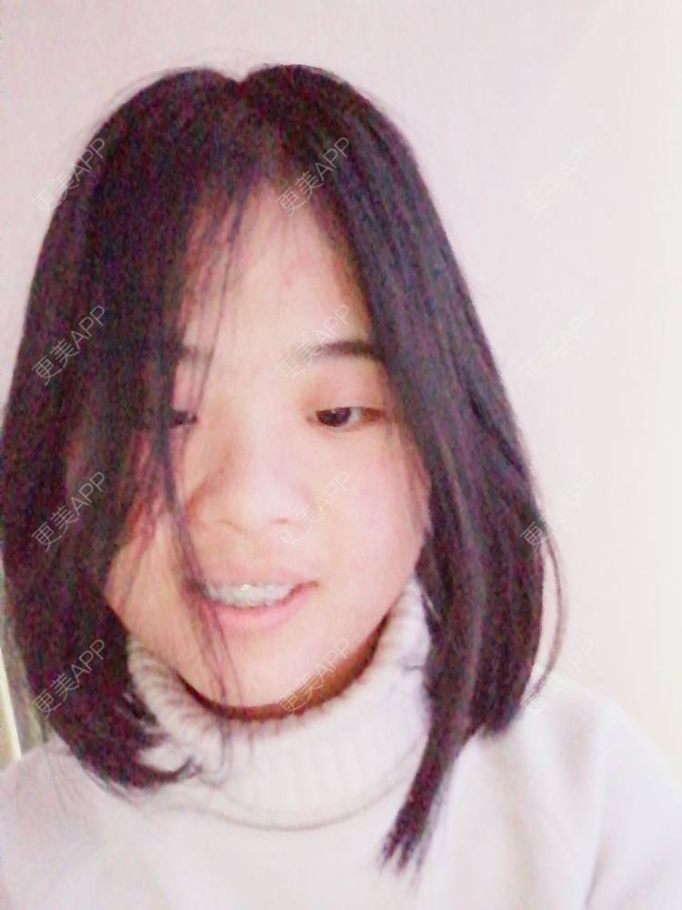 更美 - 鱼不咸咸的金属托槽矫正经验 | 金属托槽矫正 | 成都