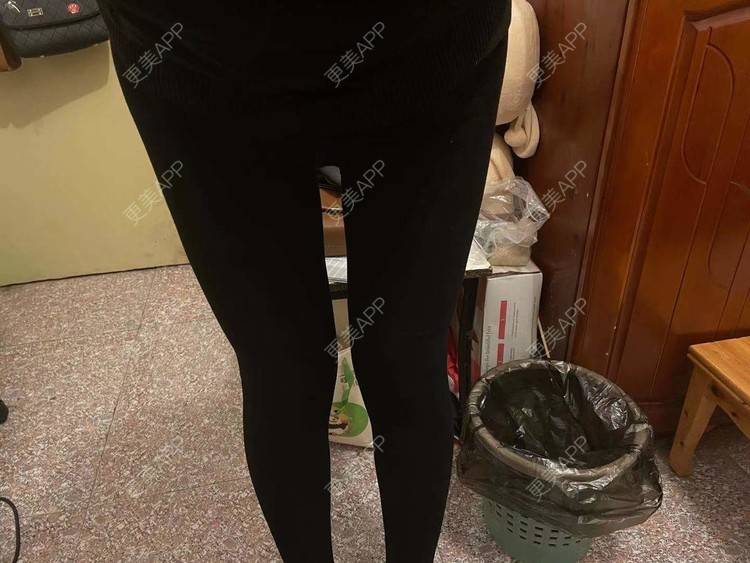 更美 - 誐吥渼、狚婧堔己的吸脂经验 | 吸脂 | 吸脂瘦大腿 | 北京 | 视频日记