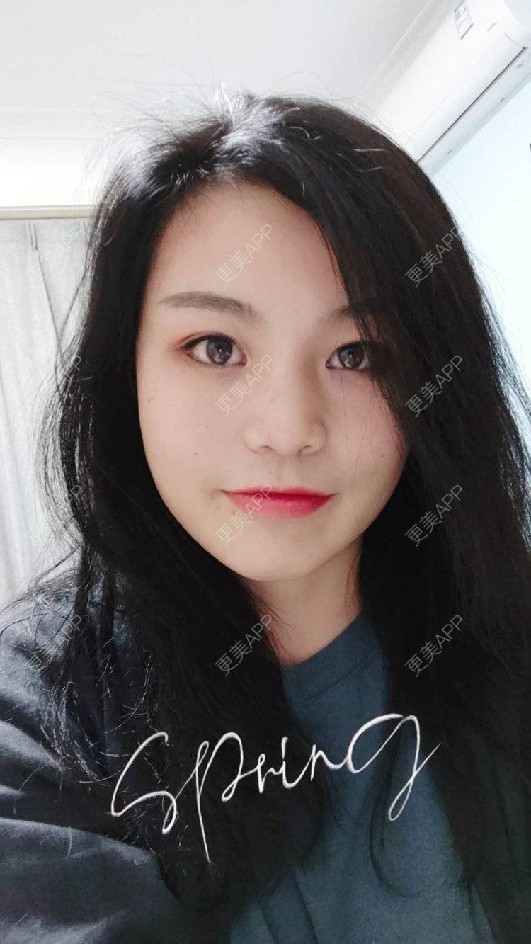 更美 - 脸小脸小的全脸整形套餐经验 | 成都 | 全脸整形套餐 | 颧骨颧弓 | 视频日记