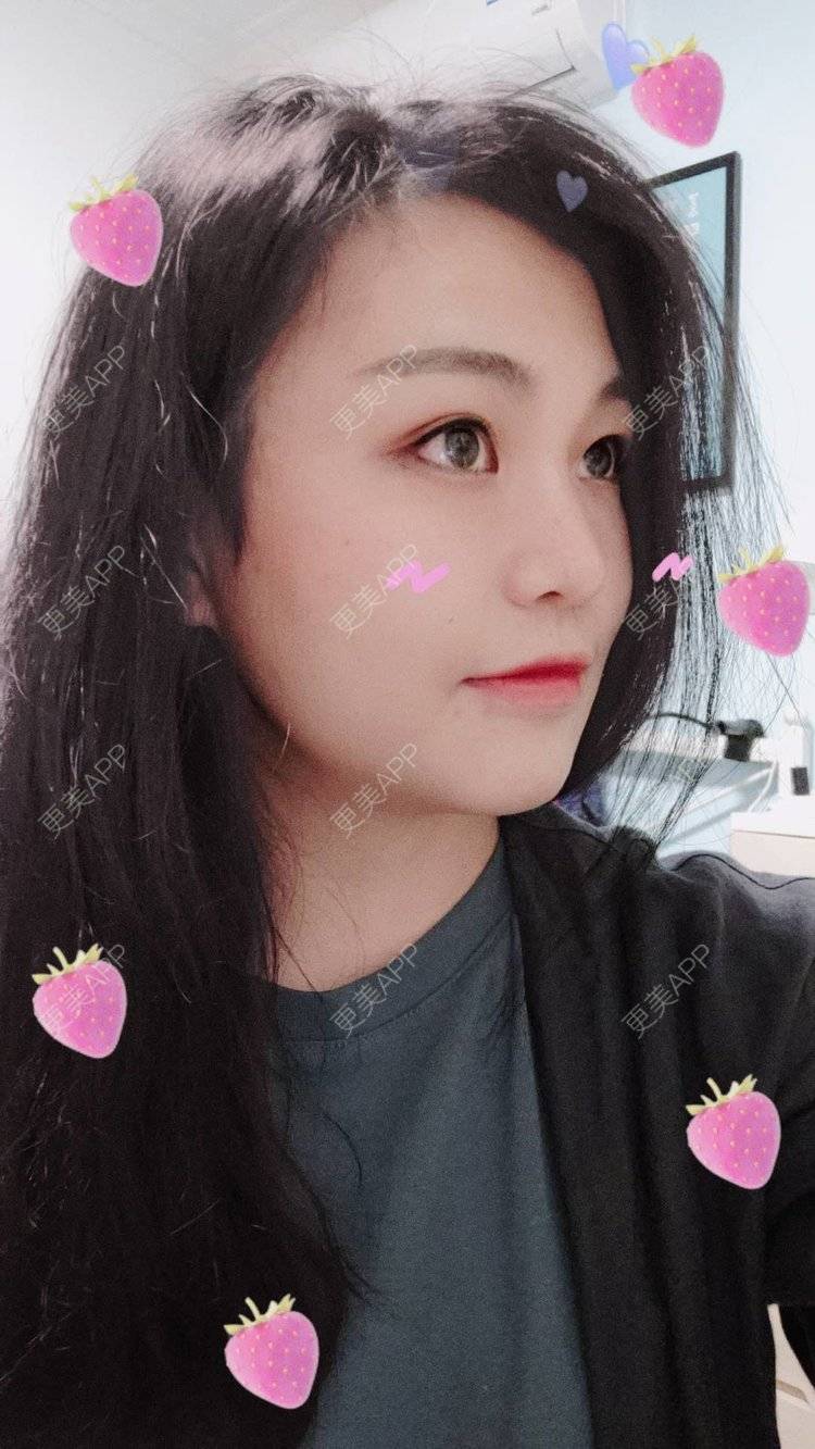 更美 - 脸小脸小的全脸整形套餐经验 | 成都 | 全脸整形套餐 | 颧骨颧弓 | 视频日记
