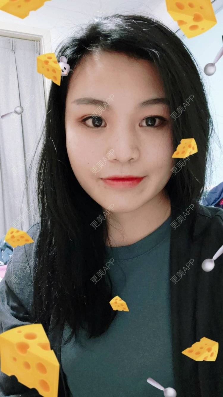 更美 - 脸小脸小的全脸整形套餐经验 | 成都 | 全脸整形套餐 | 颧骨颧弓 | 视频日记