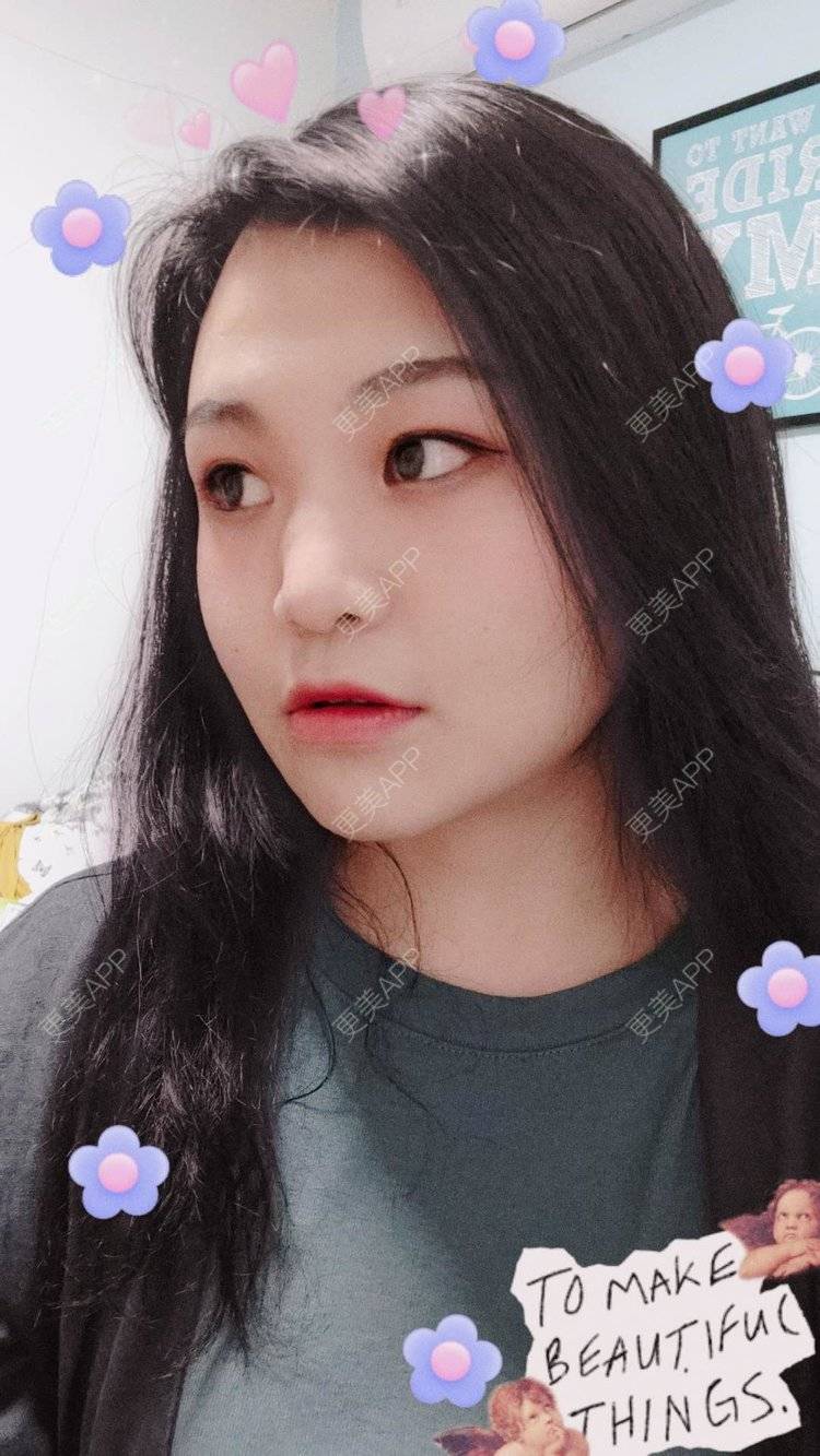 更美 - 脸小脸小的全脸整形套餐经验 | 成都 | 全脸整形套餐 | 颧骨颧弓 | 视频日记