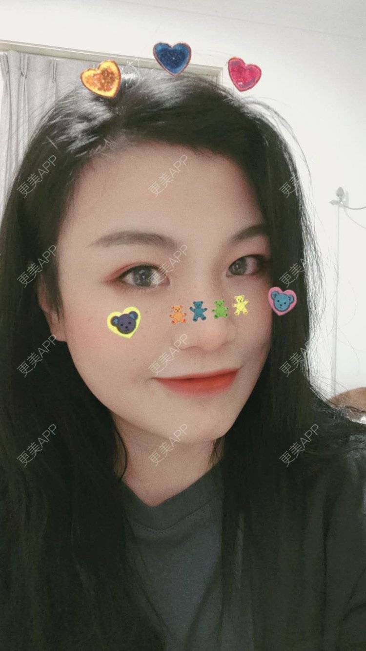 更美 - 脸小脸小的全脸整形套餐经验 | 成都 | 全脸整形套餐 | 颧骨颧弓 | 视频日记