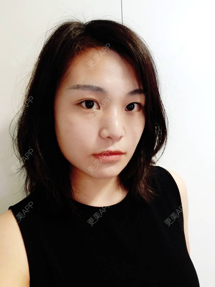 更美 - 脸小脸小的全脸整形套餐经验 | 成都 | 全脸整形套餐 | 视频日记