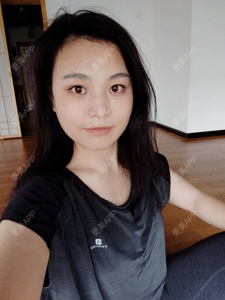 更美 - 脸小脸小的全脸整形套餐经验 | 成都 | 全脸整形套餐 | 视频日记