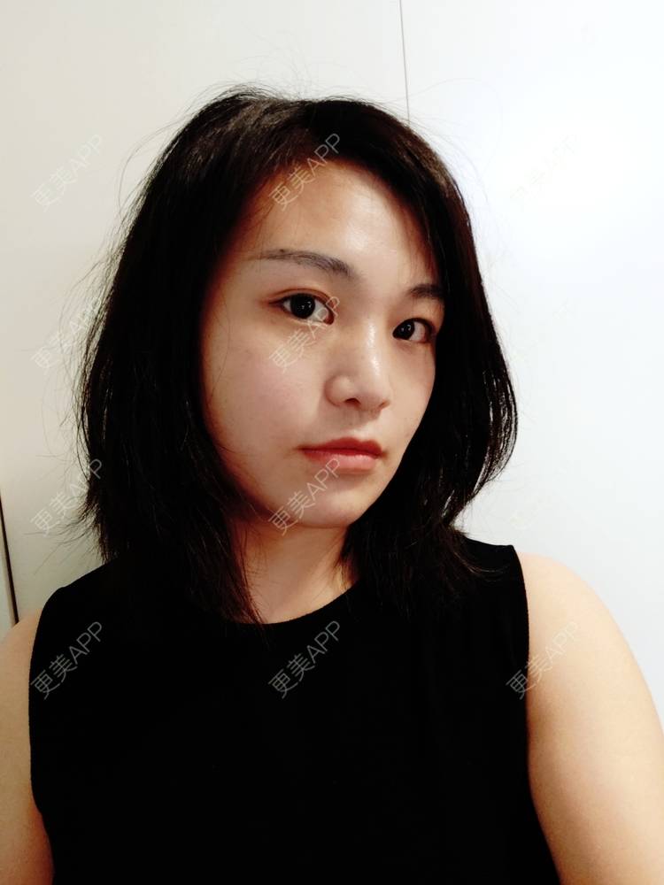 更美 - 脸小脸小的全脸整形套餐经验 | 成都 | 全脸整形套餐 | 视频日记