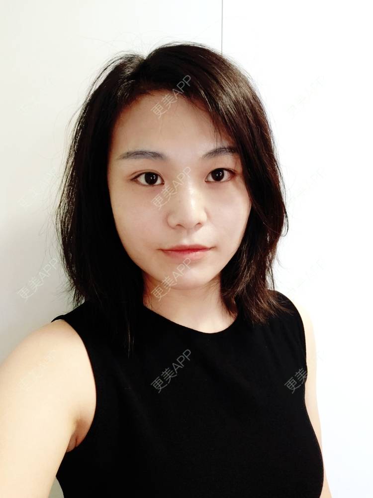 更美 - 脸小脸小的全脸整形套餐经验 | 成都 | 全脸整形套餐 | 视频日记