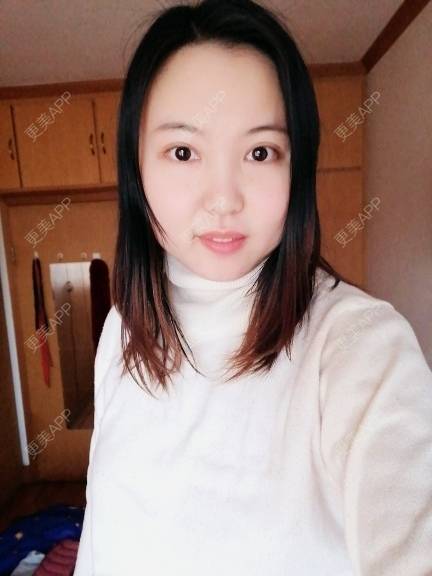 更美 - 飞咪兔兔´ω`的埋线双眼皮经验 | 埋线双眼皮 | 开内眼角 | 自体脂肪丰太阳穴 | 自体脂肪丰额头 | 内眦赘皮矫正