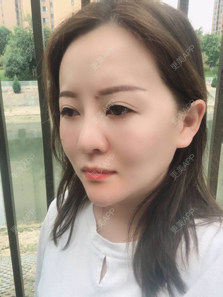 更美 - 网上冲浪专家的激光溶脂瘦脸经验 | 南昌 | 激光溶脂瘦脸