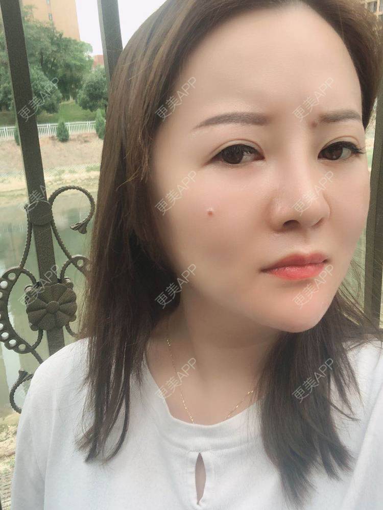 更美 - 网上冲浪专家的激光溶脂瘦脸经验 | 南昌 | 激光溶脂瘦脸