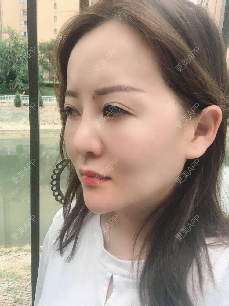 更美 - 网上冲浪专家的激光溶脂瘦脸经验 | 南昌 | 激光溶脂瘦脸