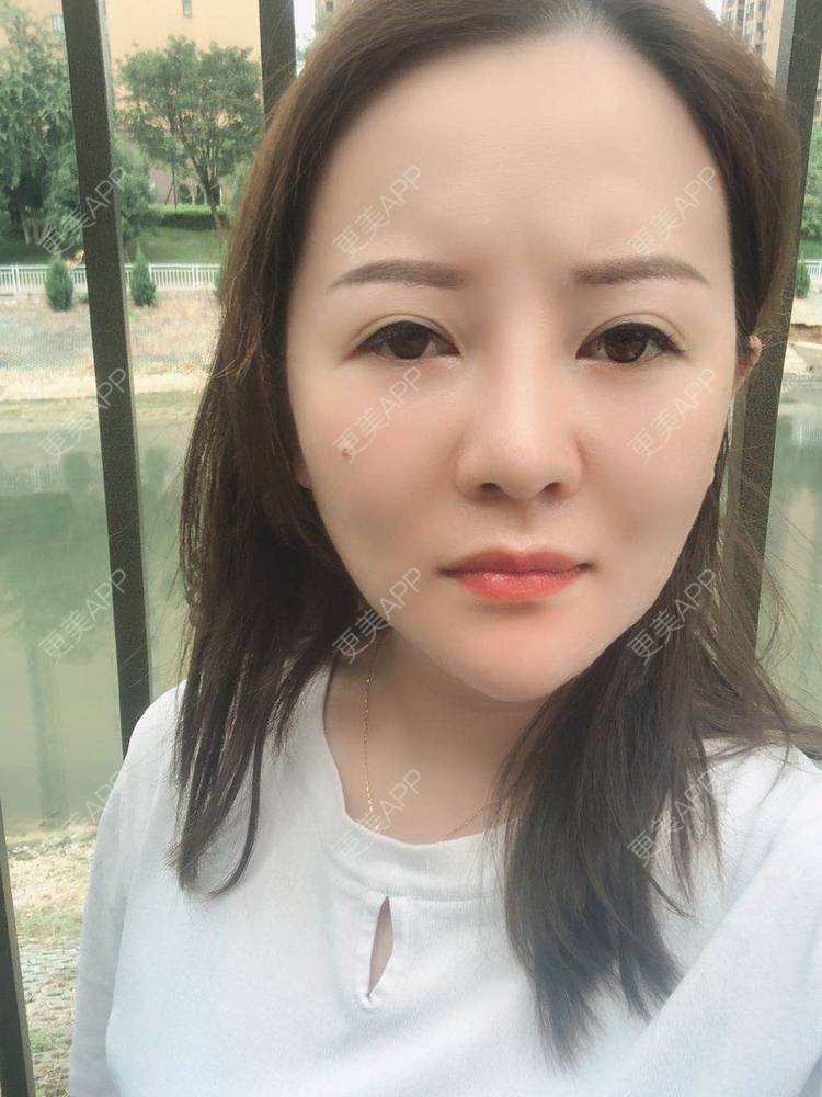 更美 - 网上冲浪专家的激光溶脂瘦脸经验 | 南昌 | 激光溶脂瘦脸