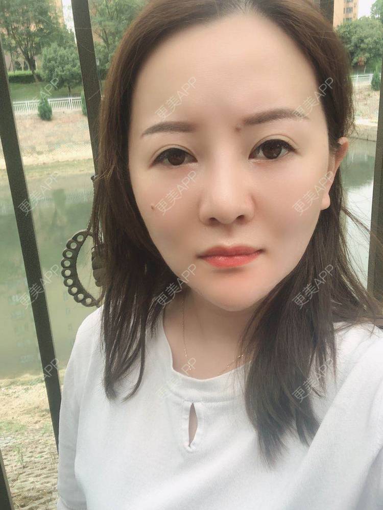 更美 - 网上冲浪专家的激光溶脂瘦脸经验 | 南昌 | 激光溶脂瘦脸