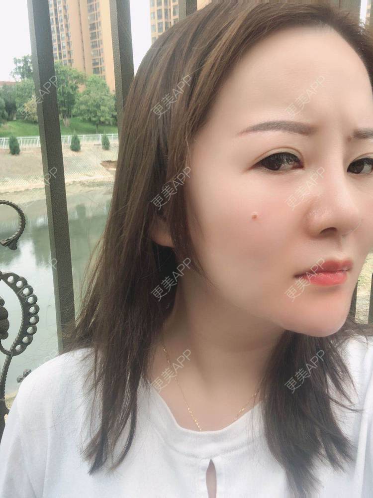 更美 - 网上冲浪专家的激光溶脂瘦脸经验 | 南昌 | 激光溶脂瘦脸
