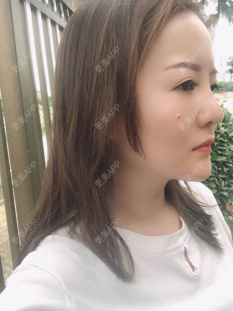 更美 - 网上冲浪专家的激光溶脂瘦脸经验 | 南昌 | 激光溶脂瘦脸