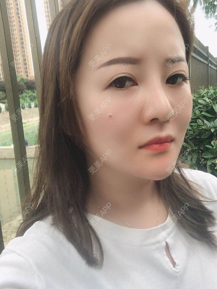 更美 - 网上冲浪专家的激光溶脂瘦脸经验 | 南昌 | 激光溶脂瘦脸