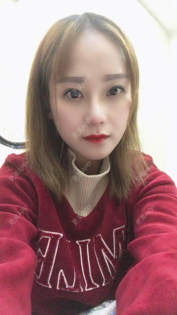 更美 - 更美用户EMNpjPf7Gn的下颌角经验 | 上海 | 颧骨内推 | 下颌角