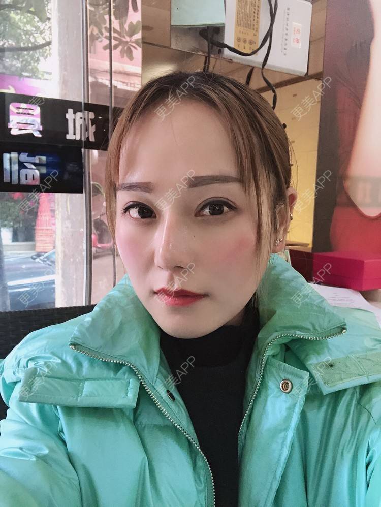 更美 - 更美用户EMNpjPf7Gn的下颌角经验 | 上海 | 颧骨内推 | 下颌角