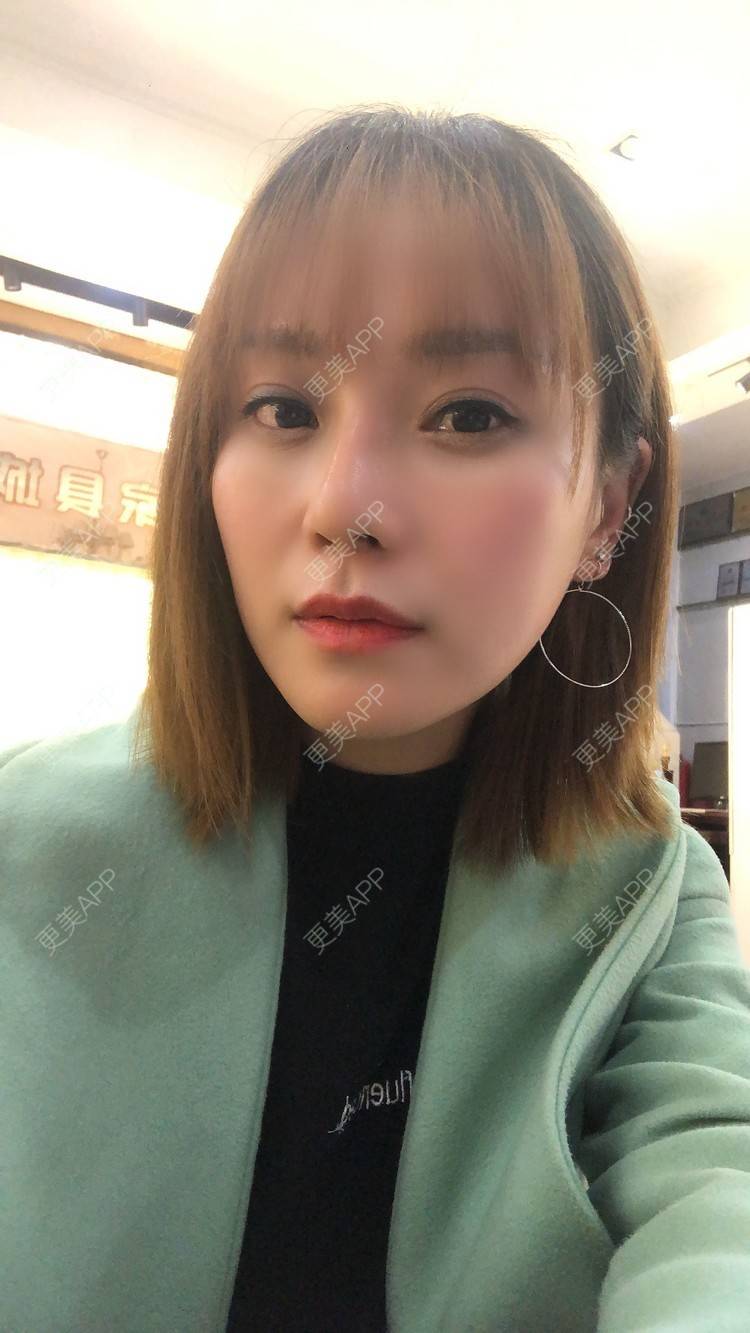 更美 - 更美用户EMNpjPf7Gn的下颌角经验 | 上海 | 下颌角 | 颧骨颧弓 | V脸套餐
