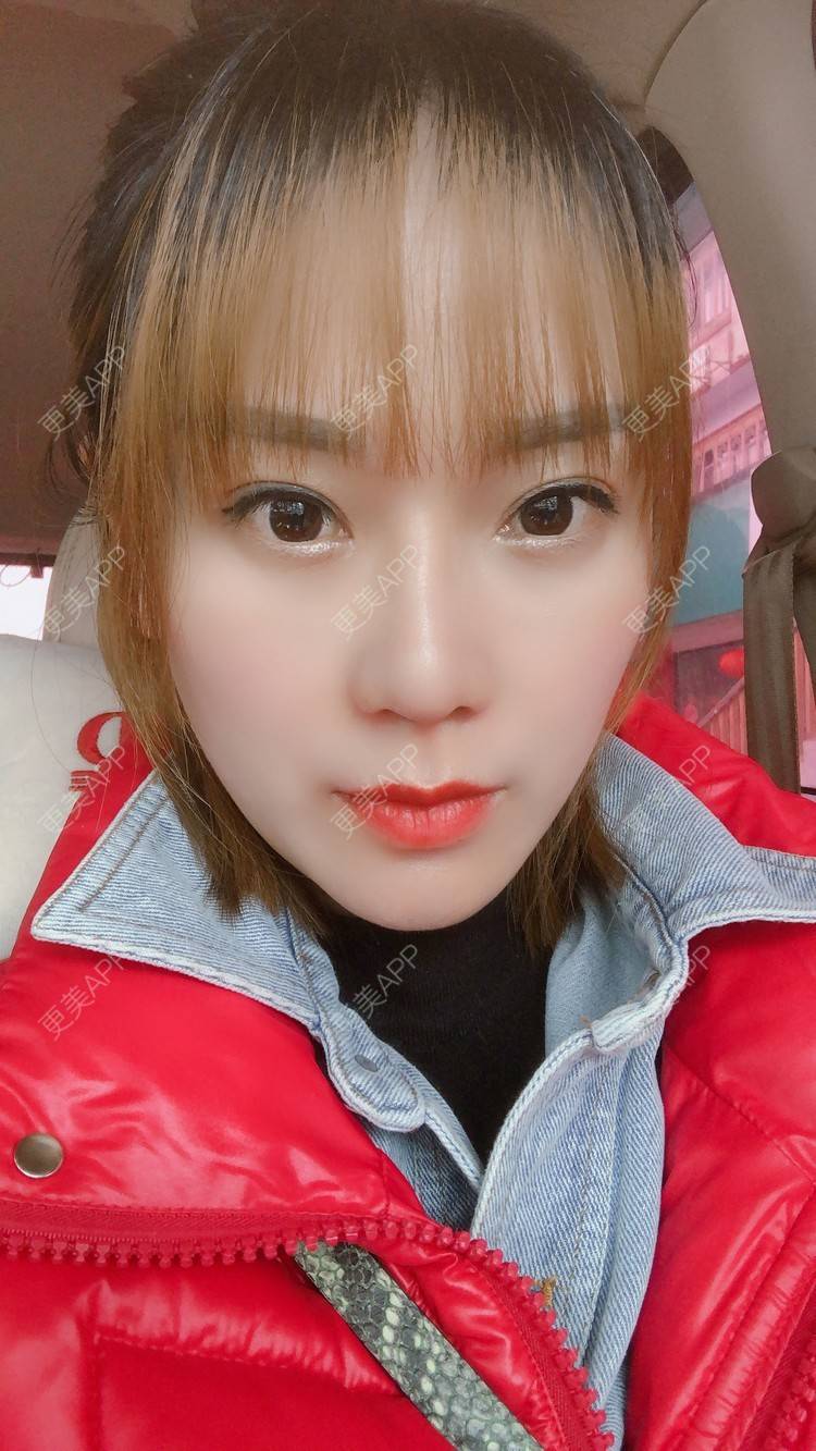 更美 - 更美用户EMNpjPf7Gn的下颌角经验 | 上海 | 下颌角 | 颧骨颧弓 | V脸套餐