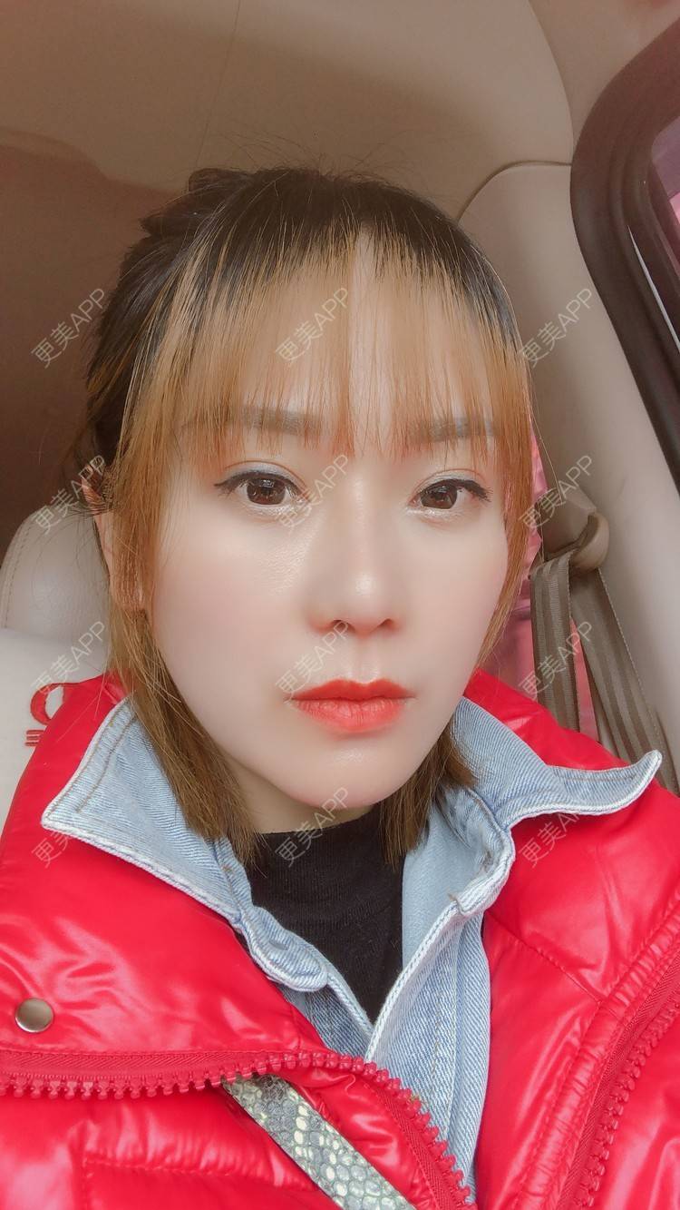 更美 - 更美用户EMNpjPf7Gn的下颌角经验 | 上海 | 下颌角 | 颧骨颧弓 | V脸套餐