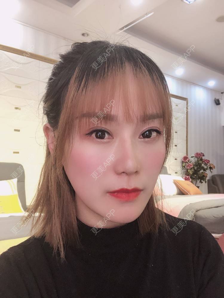 更美 - 更美用户EMNpjPf7Gn的下颌角经验 | 上海 | 下颌角 | 颧骨颧弓 | V脸套餐
