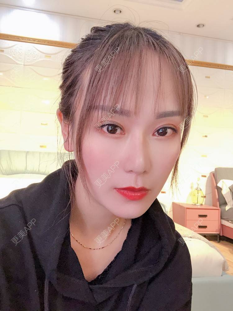 更美 - 更美用户EMNpjPf7Gn的下颌角经验 | 上海 | 颧骨内推 | 下颌角 | 轮廓套餐