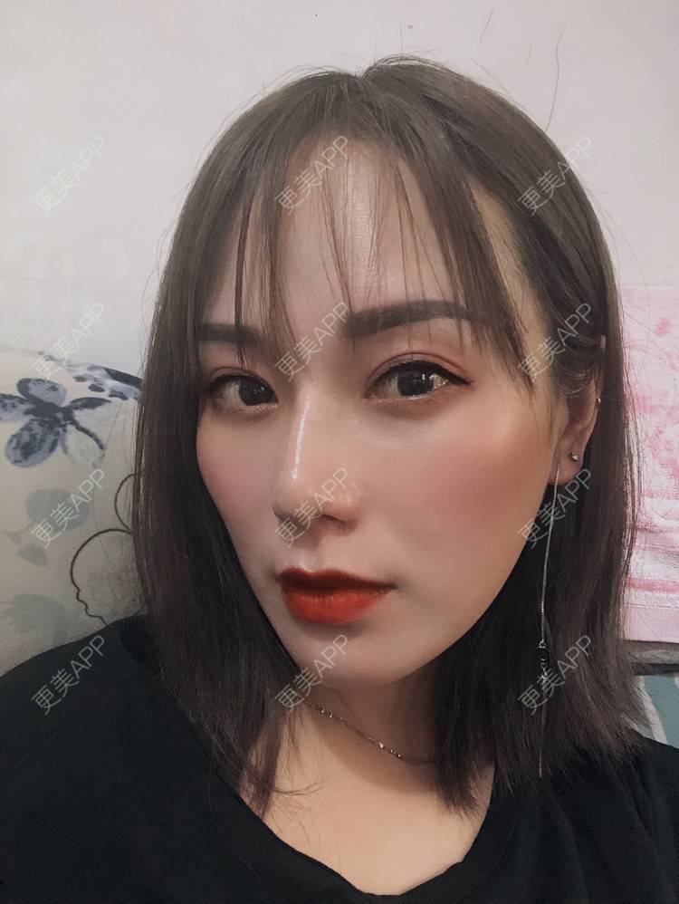 更美 - 更美用户EMNpjPf7Gn的下颌角经验 | 上海 | 颧骨内推 | 下颌角 | 轮廓套餐