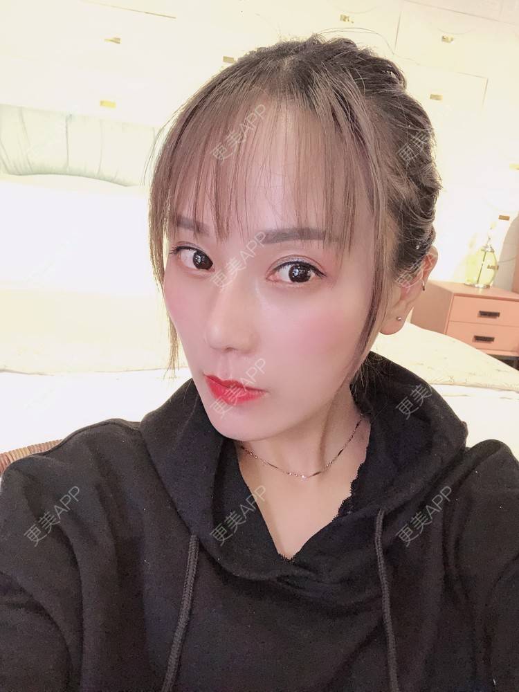 更美 - 更美用户EMNpjPf7Gn的下颌角经验 | 上海 | 颧骨内推 | 下颌角 | 轮廓套餐