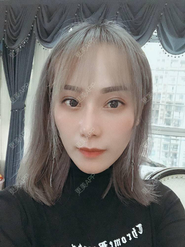 更美 - 更美用户EMNpjPf7Gn的下颌角经验 | 上海 | 全脸整形套餐 | 下颌角 | 颧骨内推