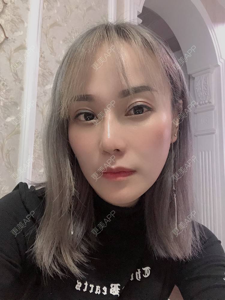 更美 - 更美用户EMNpjPf7Gn的下颌角经验 | 上海 | 全脸整形套餐 | 下颌角 | 颧骨内推
