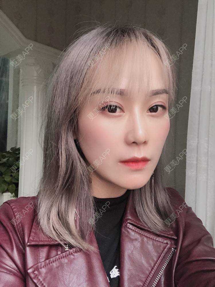 更美 - 更美用户EMNpjPf7Gn的下颌角经验 | 上海 | 全脸整形套餐 | 下颌角 | 颧骨内推