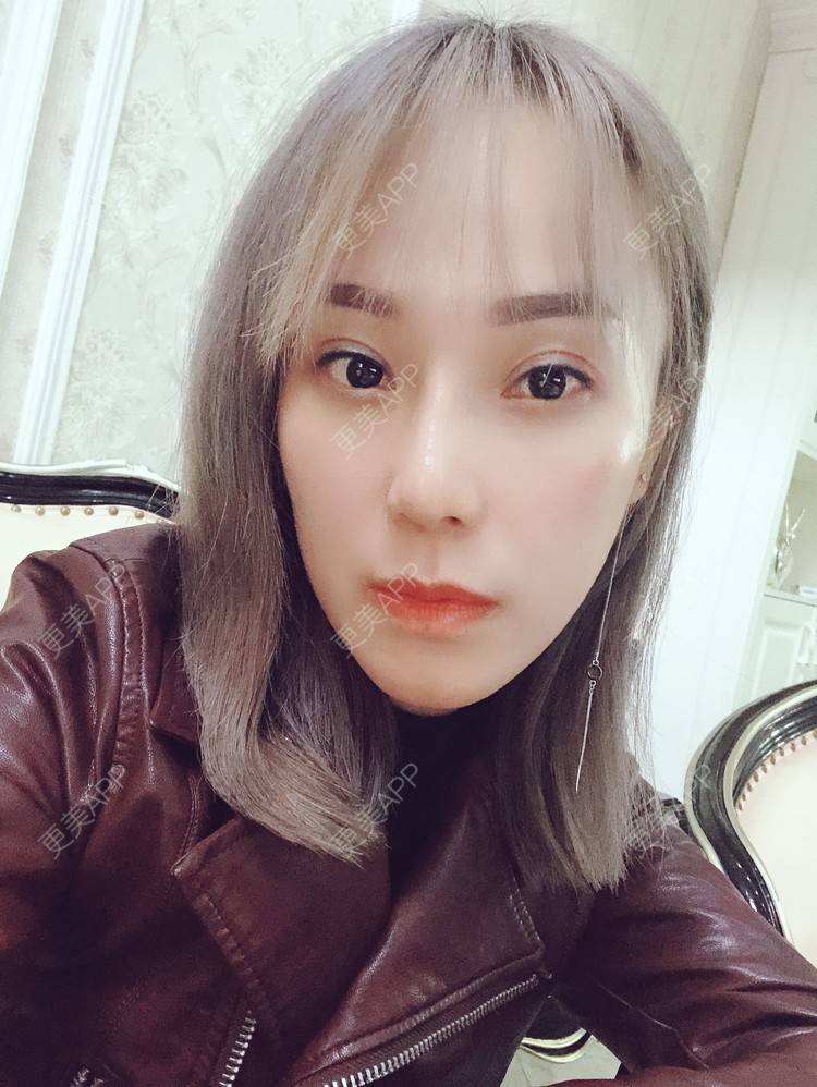 更美 - 更美用户EMNpjPf7Gn的下颌角经验 | 上海 | 全脸整形套餐 | 下颌角 | 颧骨内推