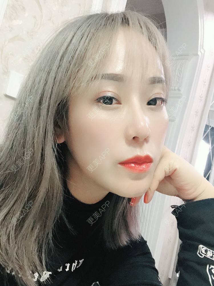 更美 - 更美用户EMNpjPf7Gn的下颌角经验 | 上海 | 全脸整形套餐 | 下颌角 | 颧骨内推