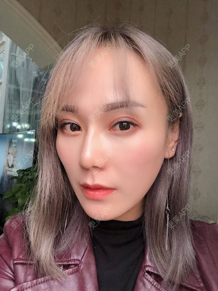 更美 - 更美用户EMNpjPf7Gn的下颌角经验 | 上海 | 全脸整形套餐 | 下颌角 | 颧骨内推